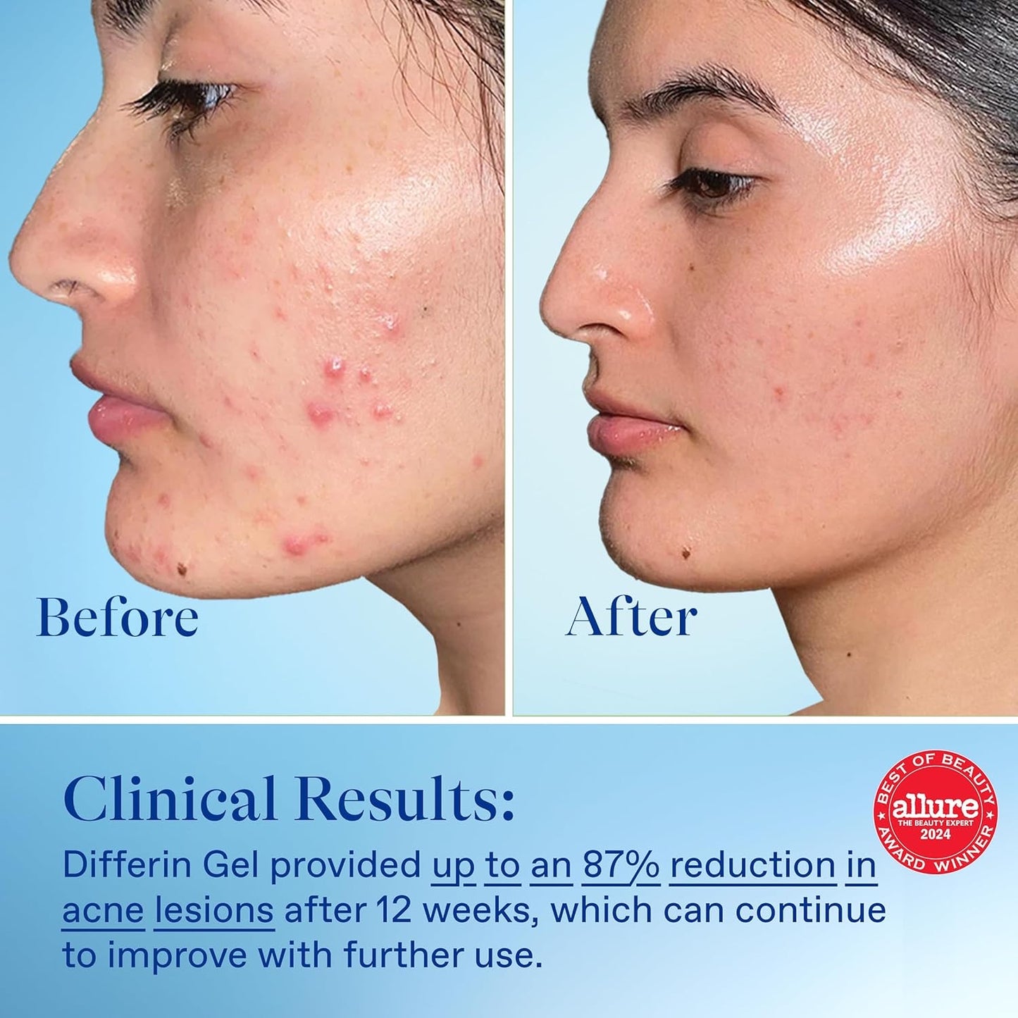 Differin Acne Treatment Gel – 0.1% Adapalene Retinoid – 45g Pump (90-Day Supply) – Gentle Skincare for Acne-Prone Sensitive Skin